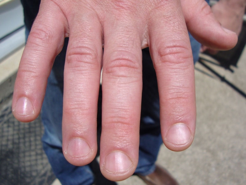 Do you see any liver related issues with these nails?